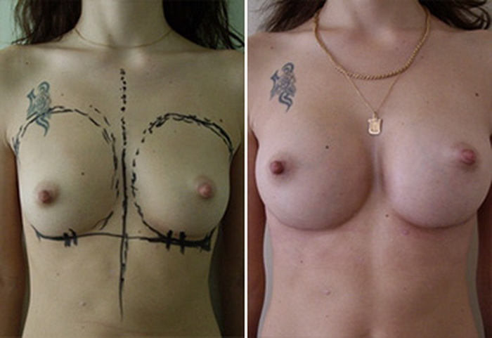 Фото: увеличение груди - Галерея 4