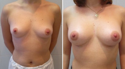  Увеличение груди