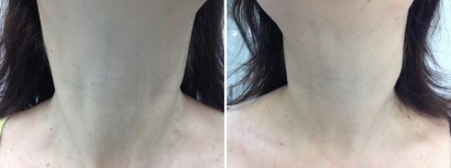 Дот-омоложение - лазерный пилинг (терапия) кожи