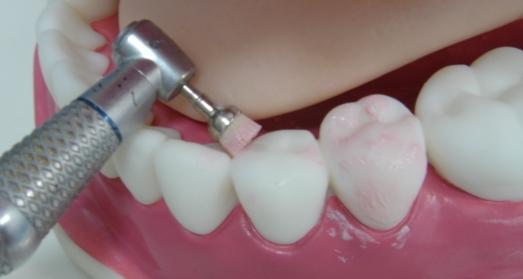 покрытие зубов фтором