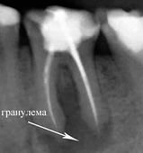 гранулема зуба