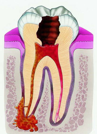 лечение гранулемы зуба