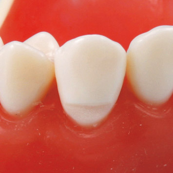 зубной клиновидный дефект