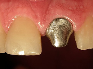 вкладка для восстановления зуба