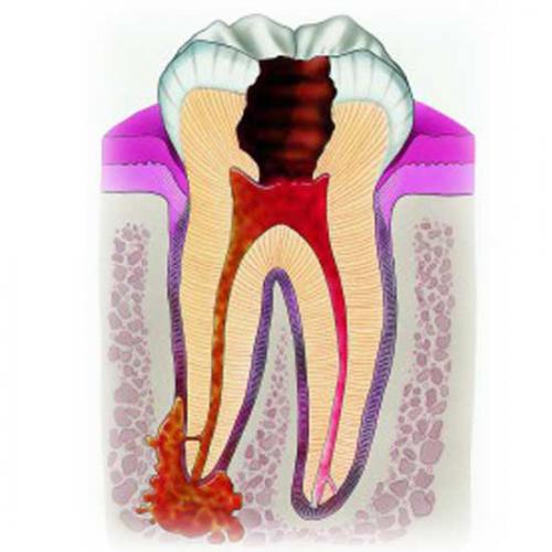 воспаление тканей зуба