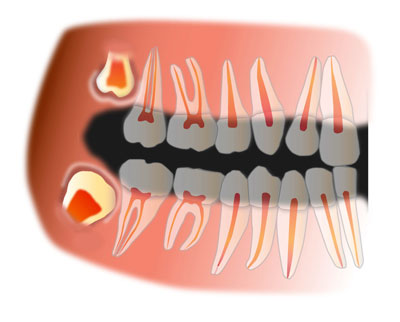 ретенция зуба