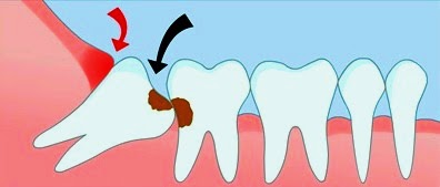 непрорезавшиеся зубы