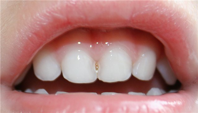 серебрение зубов 