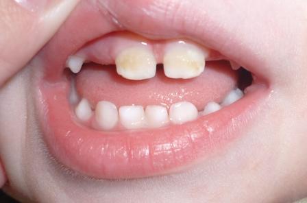 серебрение зубной поверхности