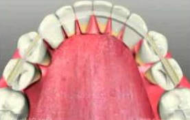 укрепление зубов шинами