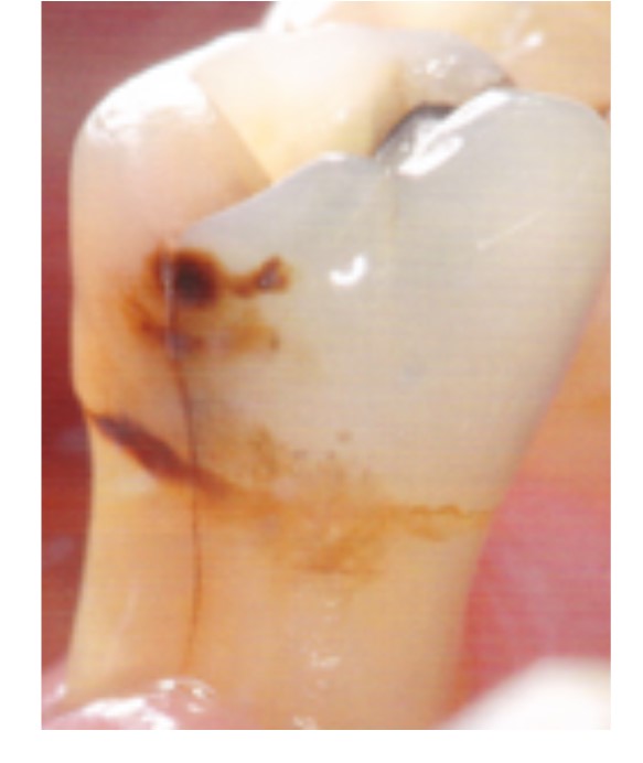 лечение зубов вертикальная трещина