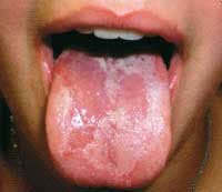 воспаление слизистой рта у детей