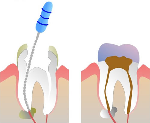 удаление нерва зуба 