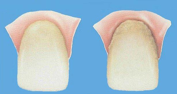 отложения на зубах