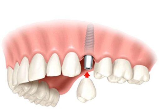 современная имплантация зубов