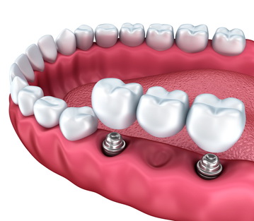  Отсутствие зубов имплантация