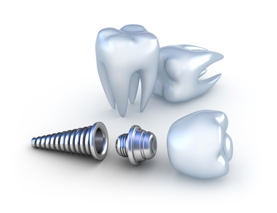 Стоматология по имплантации зубов